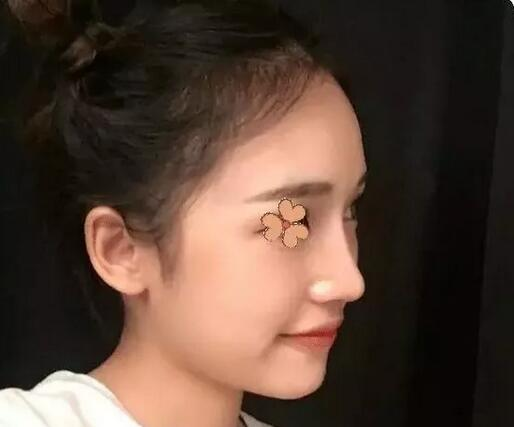 深圳福華整形陳貞宜超體隆鼻術后一個月效果反饋，有圖