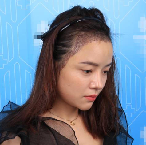 廈門新生植發(fā)種植發(fā)際線半個(gè)月