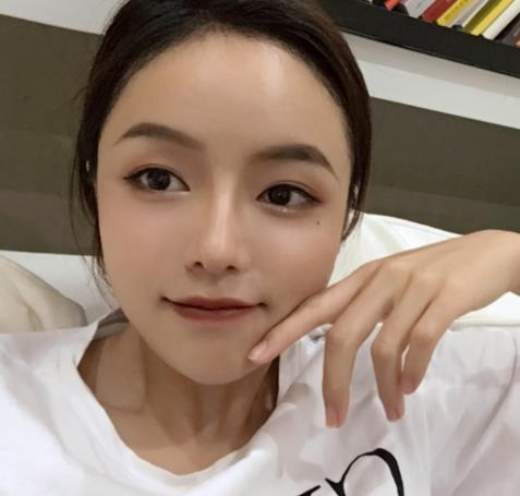 廈門新生植發(fā)種植發(fā)際線半年效果分享，一鍵get高顱頂