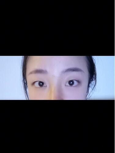 西安時光整形郭淑華雙眼皮案例術前