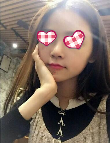 北京葉子整形膨體隆鼻兩個(gè)月效果分享，高級(jí)感側(cè)顏殺