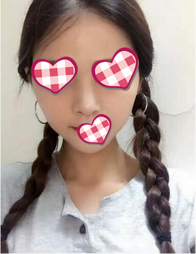 北京葉子整形膨體隆鼻術(shù)后一個月效果