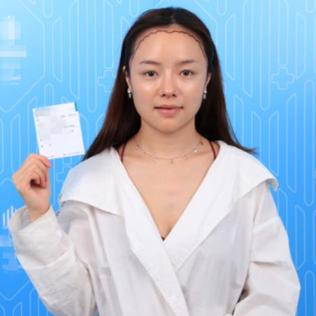 廈門新生植發(fā)種植發(fā)際線半年效果分享，一鍵get高顱頂