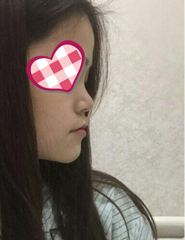 北京葉子整形膨體隆鼻兩個(gè)月效果分享，高級(jí)感側(cè)顏殺