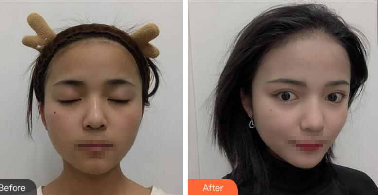 長沙愛思特整形定點雙眼皮案例分享，蘿莉到御姐的轉變