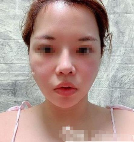 南京閱顏整形瘦臉針注射后八天 南京閱顏整形瘦臉針注射后八天