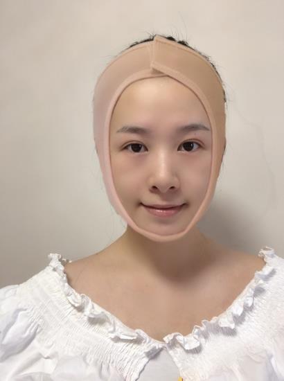 南方醫(yī)院整形美容科顴骨內(nèi)推術(shù)后一周 南方醫(yī)院整形美容科顴骨內(nèi)推術(shù)后一周