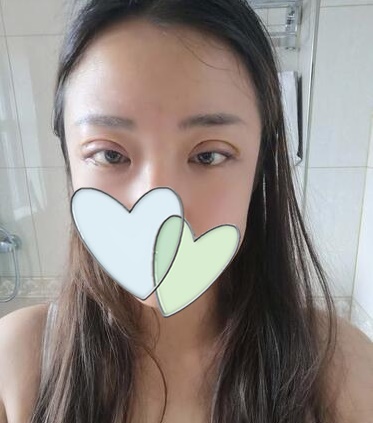 西安時光整形郭淑華雙眼皮案例術后一周