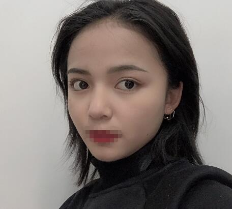 長沙愛思特整形定點雙眼皮案例分享，蘿莉到御姐的轉變