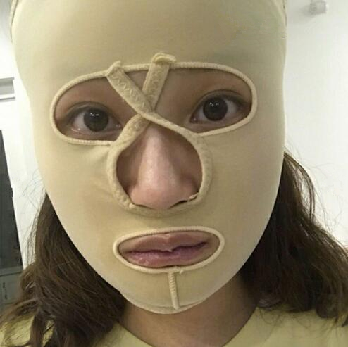 重慶美聯(lián)臣下頜角整形半個(gè)月效果 重慶美聯(lián)臣下頜角整形半個(gè)月效果