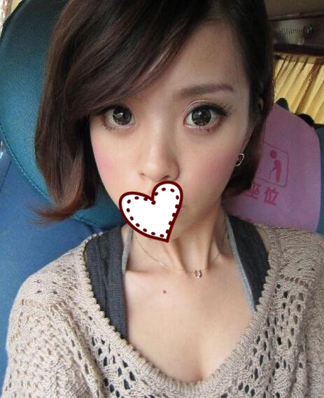 鄭州蘊美整形玻尿酸隆鼻一周效果 鄭州蘊美整形玻尿酸隆鼻一周效果