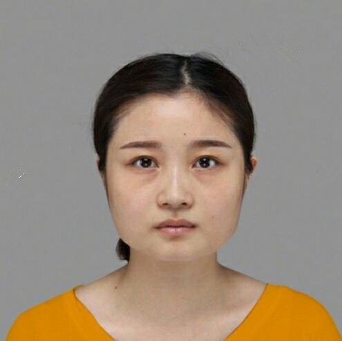 重慶美聯(lián)臣下頜角整形術(shù)后三個月效果反饋，一定要忌嘴