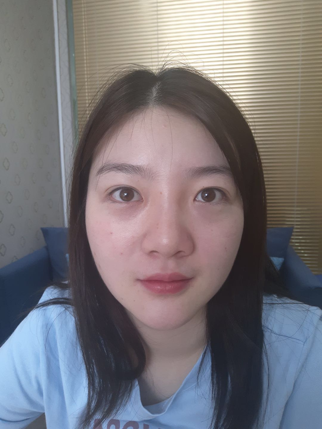 北京圣嘉榮二次鼻修復(fù)前 北京圣嘉榮二次鼻修復(fù)前