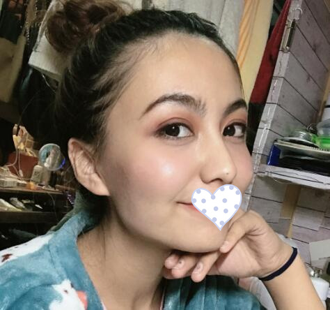 徐州時光洪揚整形雙眼皮術(shù)后一個月效果 徐州時光洪揚整形雙眼皮術(shù)后一個月效果