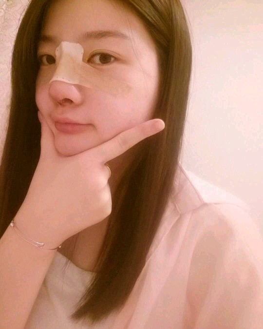 北京圣嘉榮二次鼻修復(fù)術(shù)后三天 北京圣嘉榮二次鼻修復(fù)術(shù)后三天