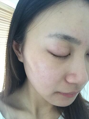 合肥艾雅整形紅藍(lán)光祛痘兩個(gè)療程效果，痘痘都消失了
