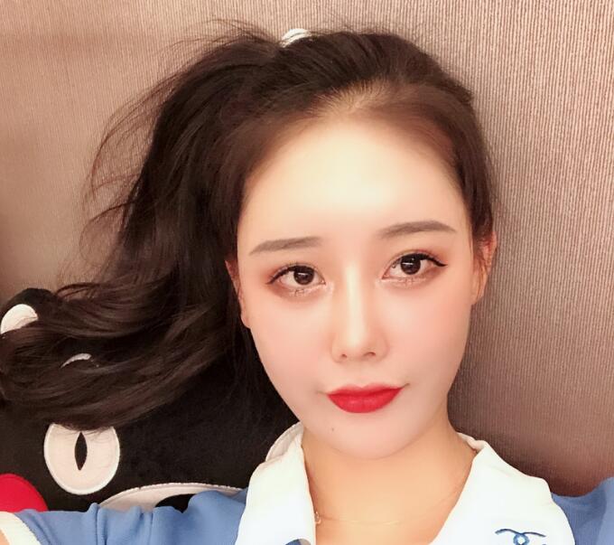 長沙亞韓整形陳明松下頜角整形一個(gè)月效果 長沙亞韓整形陳明松下頜角整形一個(gè)月效果