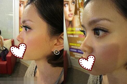 鄭州蘊美整形玻尿酸隆鼻案例分享，效果即刻看得見