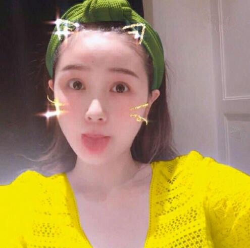 重慶美聯(lián)臣下頜角整形術(shù)后三個月效果反饋，一定要忌嘴