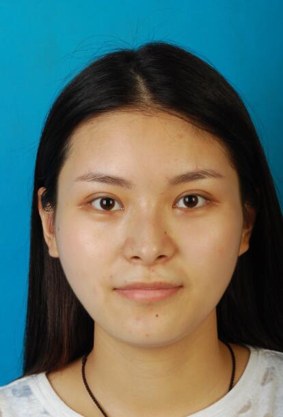 西安國(guó)際下頜角整形術(shù)后三個(gè)月正面效果 西安國(guó)際下頜角整形術(shù)后三個(gè)月正面效果