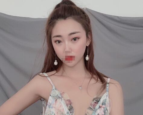 安徽省立醫(yī)院褚燕軍埋線雙眼皮一個(gè)月效果