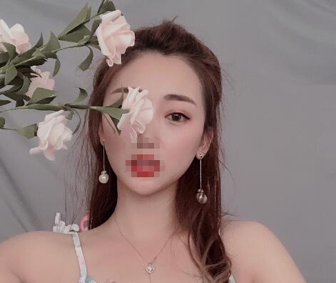 安徽省立醫(yī)院褚燕軍埋線雙眼皮一個(gè)月效果圖