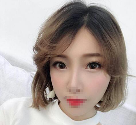 安徽省立醫(yī)院褚燕軍手術(shù)祛眼袋一個月效果 安徽省立醫(yī)院褚燕軍手術(shù)祛眼袋一個月效果