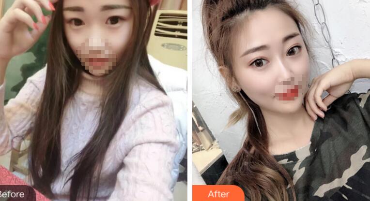 安徽省立醫(yī)院褚燕軍埋線雙眼皮前后對(duì)比圖