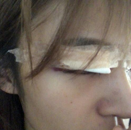 北京崔相平整形雙眼皮修復(fù)術(shù)后即刻