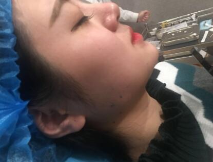 西安希美得整形瘦臉針瘦臉當(dāng)天