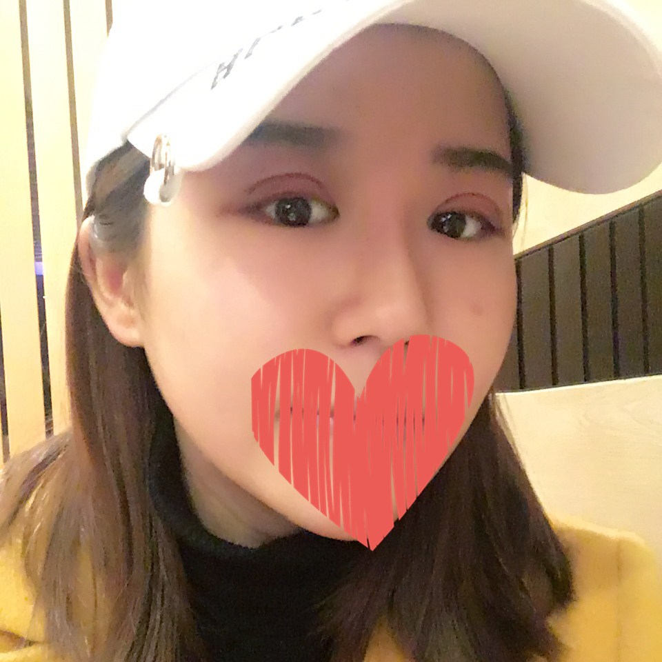 滄州中妤整形張明切開(kāi)雙眼皮拆線(xiàn)后三天效果 滄州中妤整形張明切開(kāi)雙眼皮拆線(xiàn)后三天效果