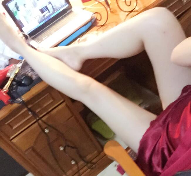 鄭州優(yōu)恩整形（原悅美）姚剛腿部吸脂三個月效果