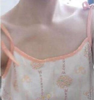 濟南悅美假體隆胸整形術后三個月效果分享