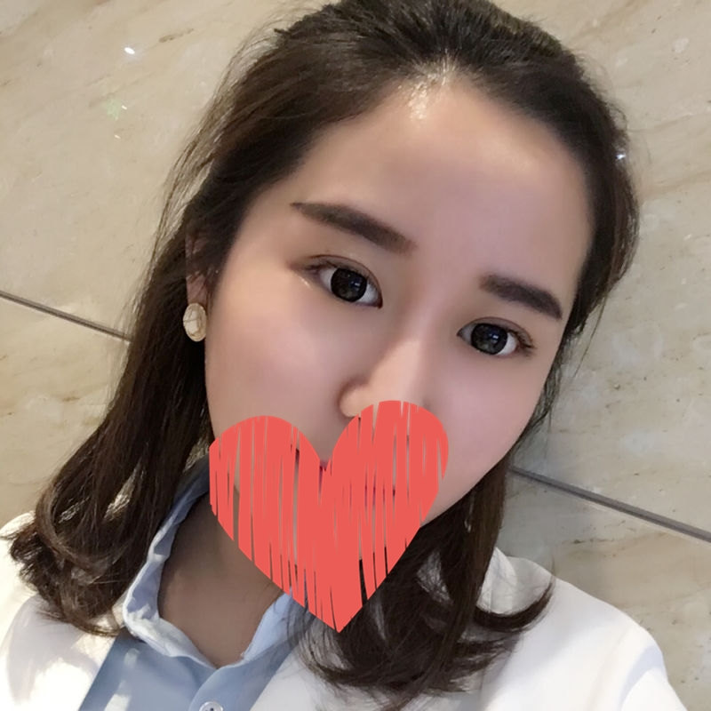 滄州中妤整形張明切開(kāi)雙眼皮兩個(gè)月效果 滄州中妤整形張明切開(kāi)雙眼皮兩個(gè)月效果