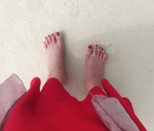 大同和平燒傷骨科醫(yī)院整形美容科大腳骨矯正術(shù)后三個月效果