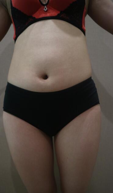 鄭州優(yōu)恩整形（原悅美）姚剛腿部吸脂前