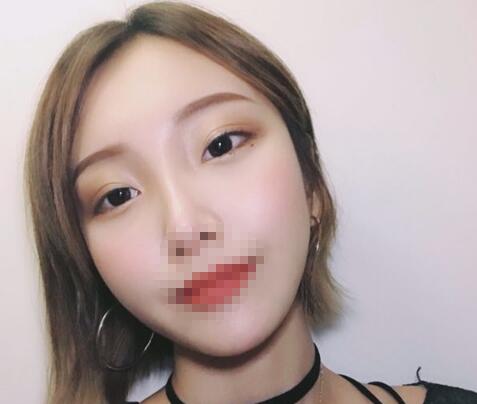 安徽省立醫(yī)院褚燕軍手術(shù)祛眼袋十天效果 安徽省立醫(yī)院褚燕軍手術(shù)祛眼袋十天效果