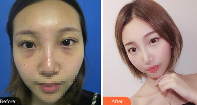 安徽省立醫(yī)院褚燕軍手術(shù)祛眼袋前后對比圖 安徽省立醫(yī)院褚燕軍手術(shù)祛眼袋前后對比圖