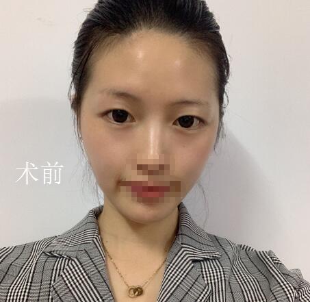 北京美萊整形杜園園雙眼皮前 北京美萊整形杜園園雙眼皮前