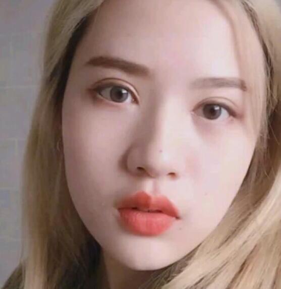 廣州中科美整形陳昌華雙下巴吸脂術(shù)后三個月效果