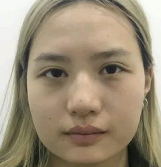 廣州中科美整形陳昌華雙下巴吸脂術(shù)前效果