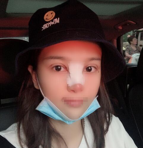 蘭州潤(rùn)妍整形鼻綜合術(shù)后三天效果