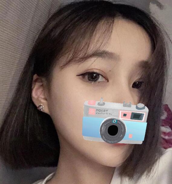 重慶華美整形下頜角整形術(shù)后一個(gè)多月效果