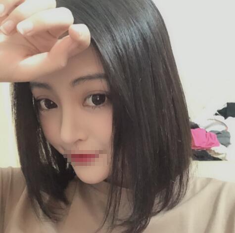 上海賽美瑞整形張化舉鼻綜合兩個(gè)月效果 上海賽美瑞整形張化舉鼻綜合兩個(gè)月效果