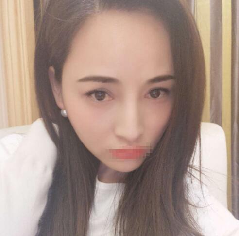 赤峰現(xiàn)代婦產(chǎn)醫(yī)院醫(yī)療美容科袁俊龍雙眼皮修復(fù)術(shù)后兩個(gè)月