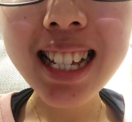 自貢華醫(yī)口腔金屬托槽矯正案例分享