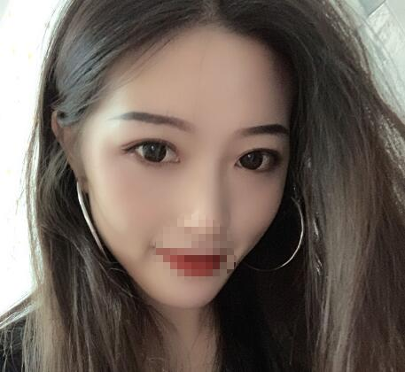 北京美萊整形杜園園雙眼皮案例分享