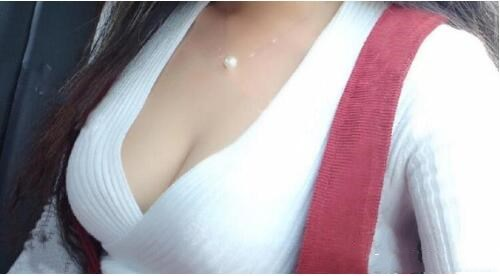 濟南悅美假體隆胸整形術后三個月效果分享