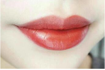 東南大學附屬中心大醫(yī)院整形外科厚唇改薄術后效果