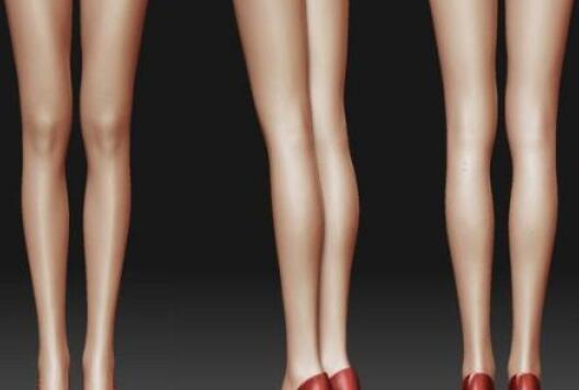 佛山市第一人民醫(yī)院整形美容小腿吸脂術后效果